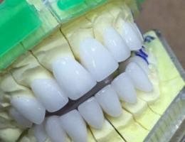 NHỮNG ƯU ĐIỂM CỦA RĂNG ZIRCONIA LÀ GÌ ?